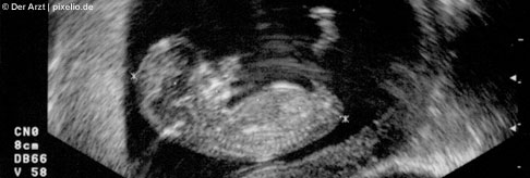 Ultraschallbild Vorsorgeuntersuchung in der Schwangerschft