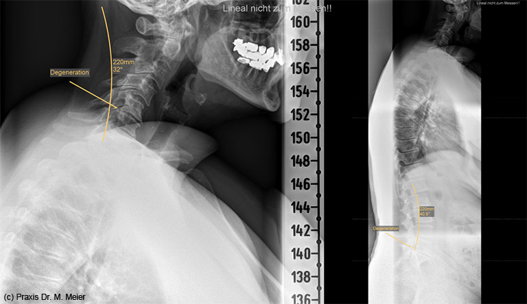 Halswirbelsäule von der Seite mit Degeneration Segment C5/6 und C6/7 und an L5/S1