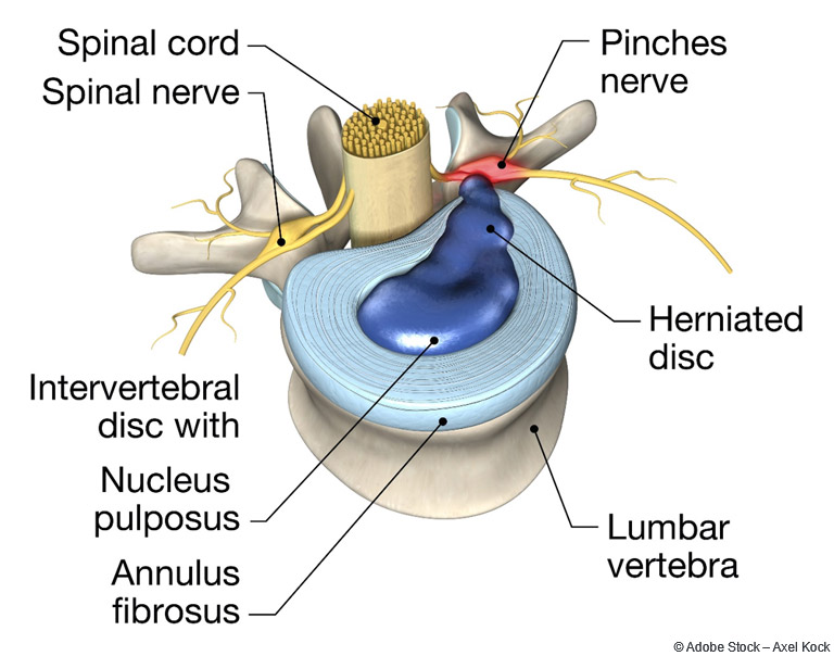 Wenn der äußere Ring aber degeneriert ist und der Bandscheibenkern vorfällt kann er die dahinterliegende Nervenwurzel bedrücken und dementsprechend Symptome auslösen.